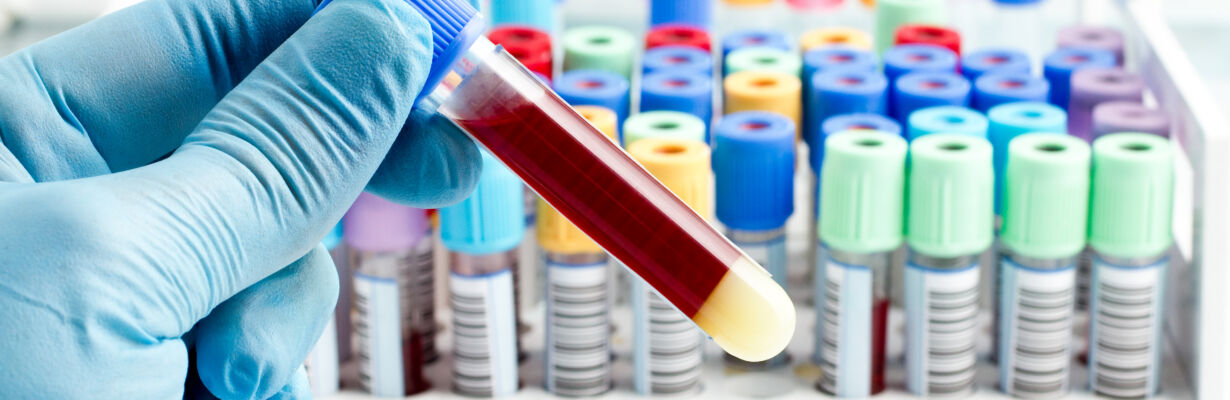 hand of a lab technician holding blood tube test and background a rack of color tubes with blood samples other patients